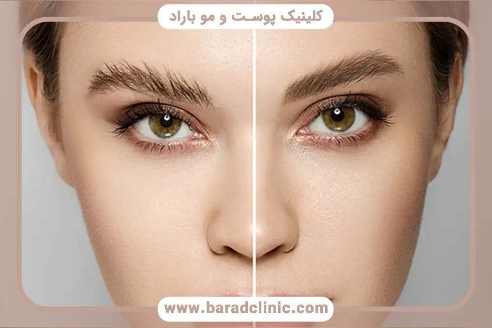 همه‌چیز درباره کاشت ابرو؛ از هزینه تا تفاوت آن با میکروکاشت ابرو